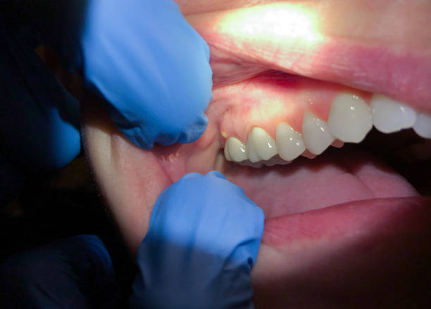 Best Broken or Cracked Tooth Emergency Dentist in Frankenmuth, MI